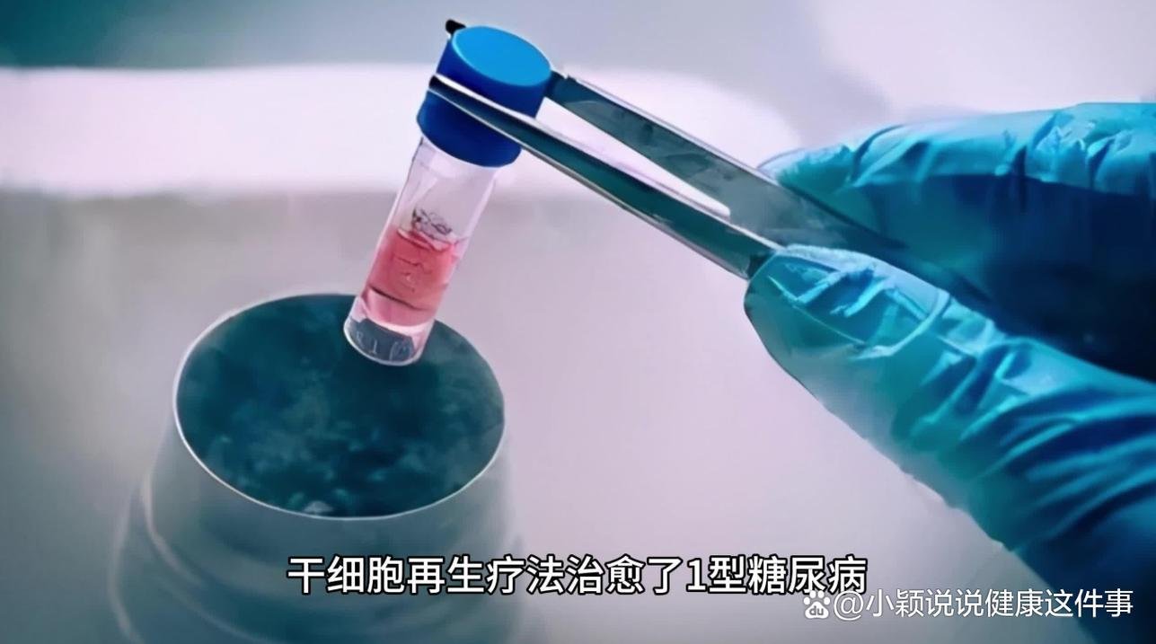 注射干细胞对糖尿病患者有作用吗_细胞疗法治疗糖尿病_细胞干预治疗糖尿病