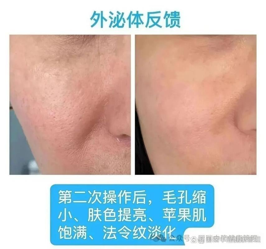 干细胞外泌体对皮肤修复作用_干细胞外泌体的作用和功效_干细胞外泌体药物