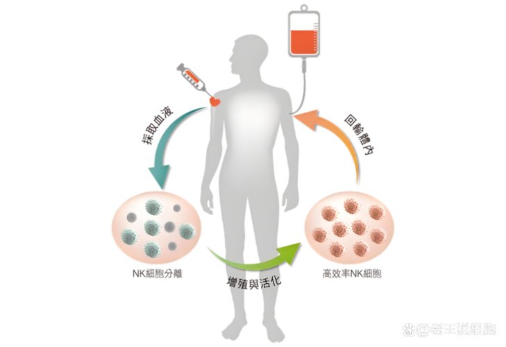 nk干细胞治疗癌症_干细胞nk治疗费用多少钱_nk干细胞的功能一次多少钱