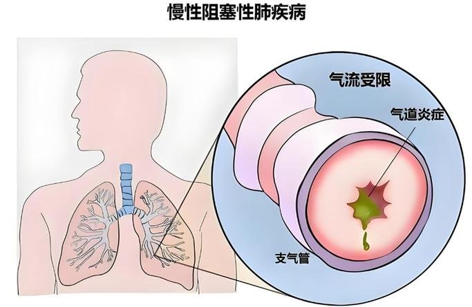 干细胞能逆转慢阻肺费用高吗_慢阻肺细胞因子_慢阻肺细胞