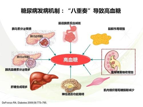 糖尿病最新消息2020年6月_2型糖尿病最新好消息_糖尿病最新现状