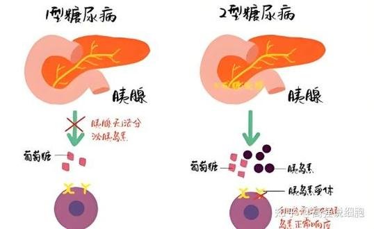 血糖干细胞多少钱一针_打一针干细胞治疗糖尿病多少钱_干细胞治疗血糖高